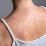 adult-measles