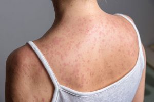 adult-measles